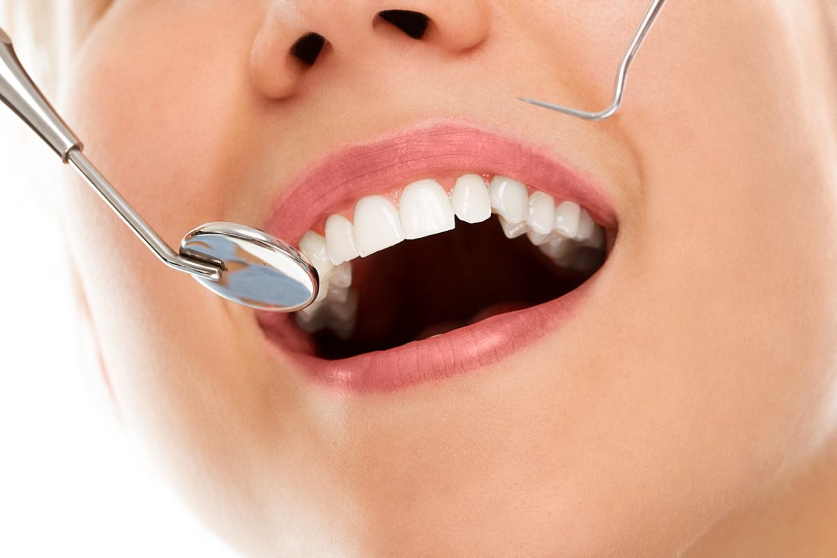 Estética Gingival vs. Carillas Dentales: Descubre la Magia Detrás de una Sonrisa Impresionante